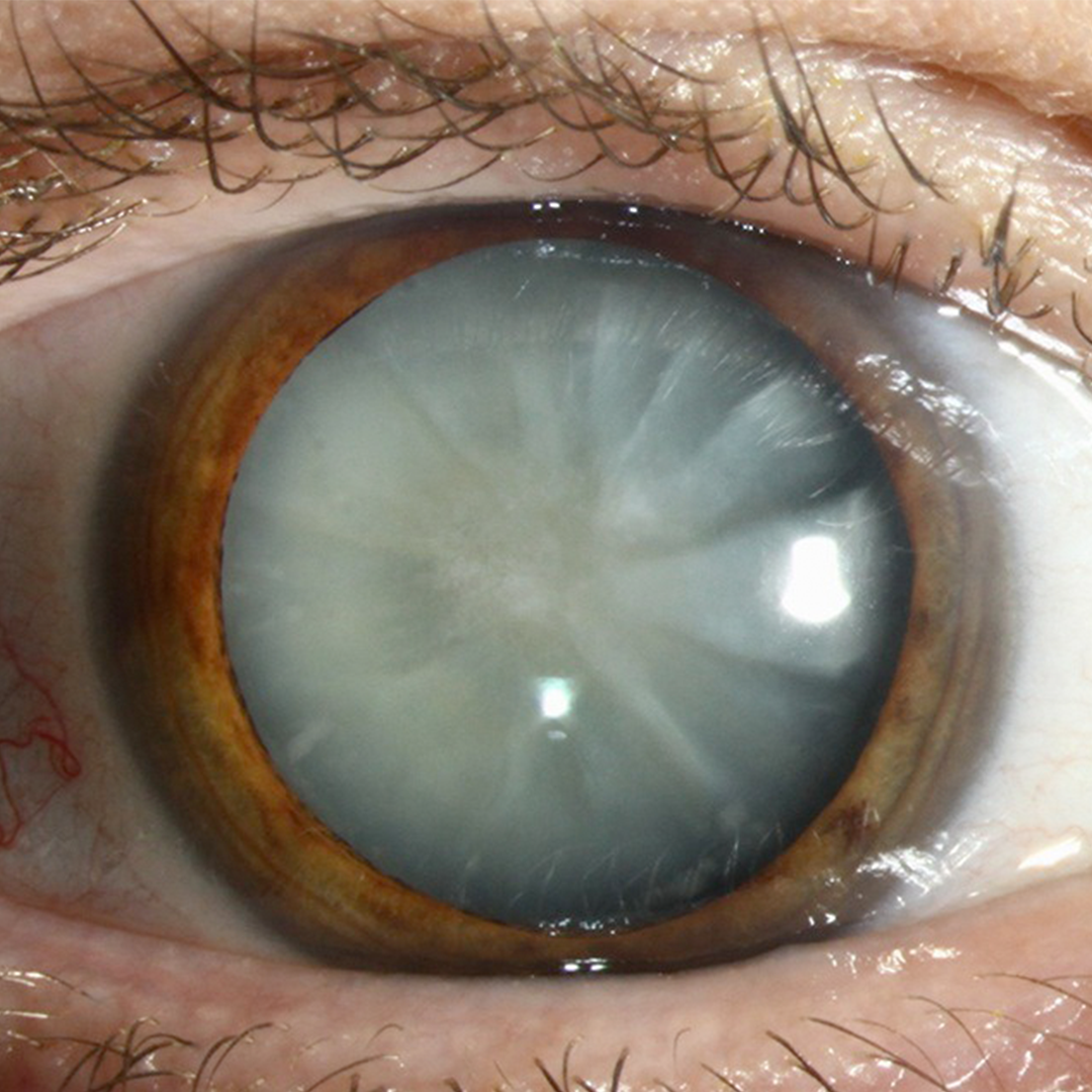 What is Myopia?